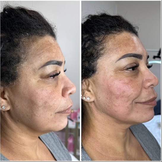 Ultraformer before and after