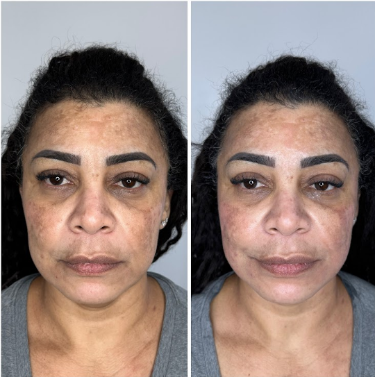 Facial treatment results